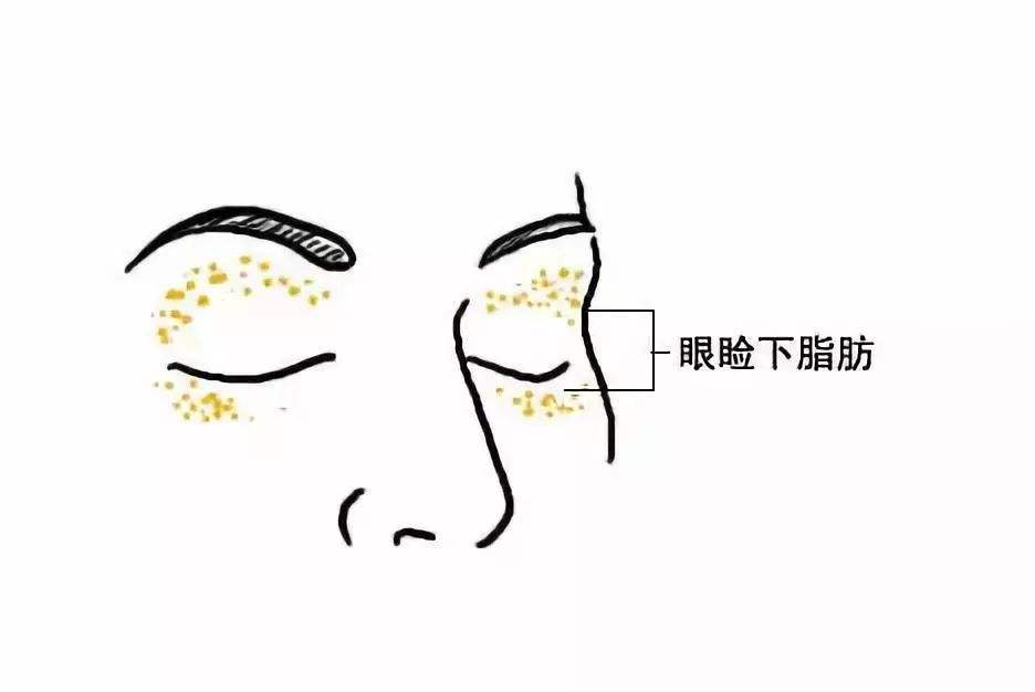 脂肪粒是怎么形成的？(图3)