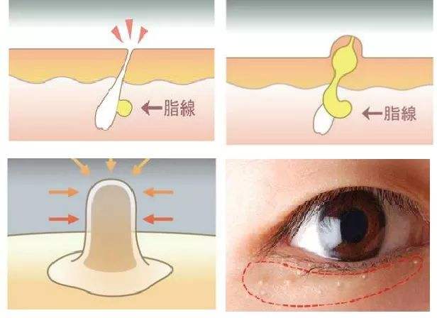 脂肪粒是怎么形成的？(图1)